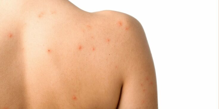 Acné corporelle : pourquoi ai-je de l’acné sur le corps ? Comment s’en débarrasser ?