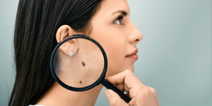 Prévenir et comprendre le cancer de la peau : protection solaire, auto-examen, symptômes et suivi dermatologique